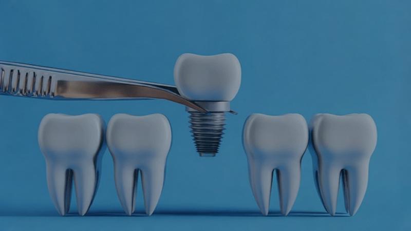 تأمین سرمایه در گردش عرضه قطعات پروتز ایمپلنت دندانپزشکی